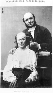 Faradisering af frontalmusklen, fra "Album de photographies pathologiques" af Duchenne de Boulogne, udgivet 1862, Paris